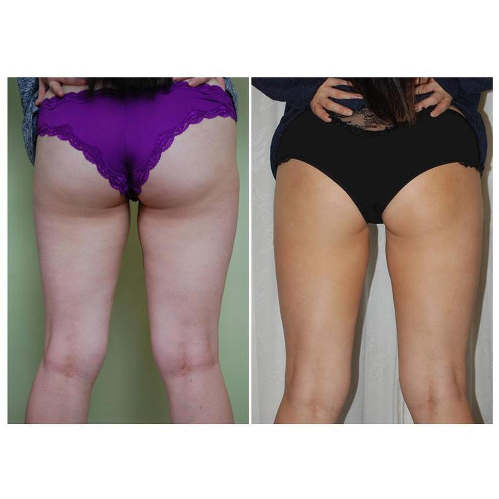 Figurite Exclusive Special Pack : Figurite Anti Cellulite Micro Encapsulated Shorts + Figurite Anti Cellulite Cream + Body Brush