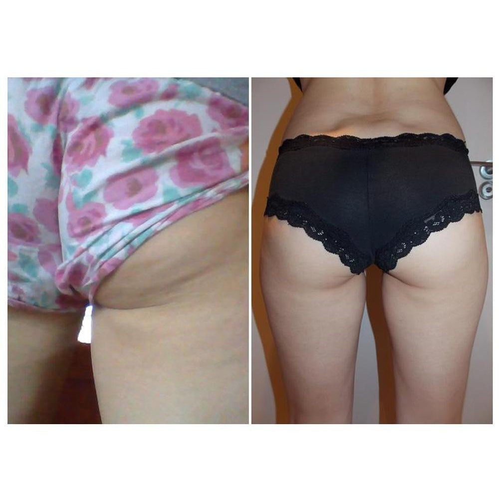 Figurite Exclusive Special Pack : Figurite Anti Cellulite Micro Encapsulated Shorts + Figurite Anti Cellulite Cream + Body Brush