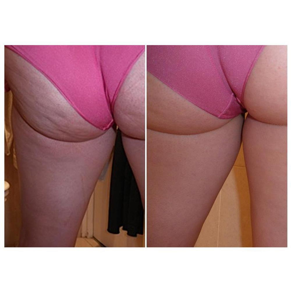 Figurite Exclusive Special Pack : Figurite Anti Cellulite Micro Encapsulated Shorts + Figurite Anti Cellulite Cream + Body Brush