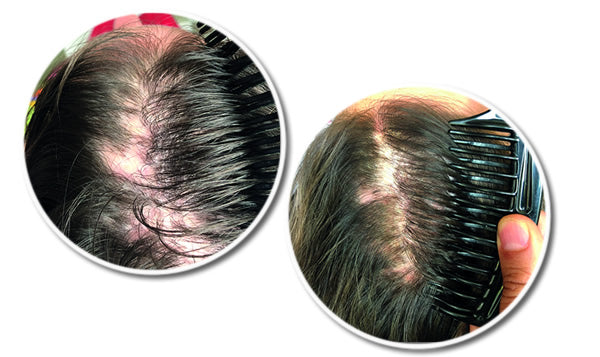   Reseed Hair Loss Range 